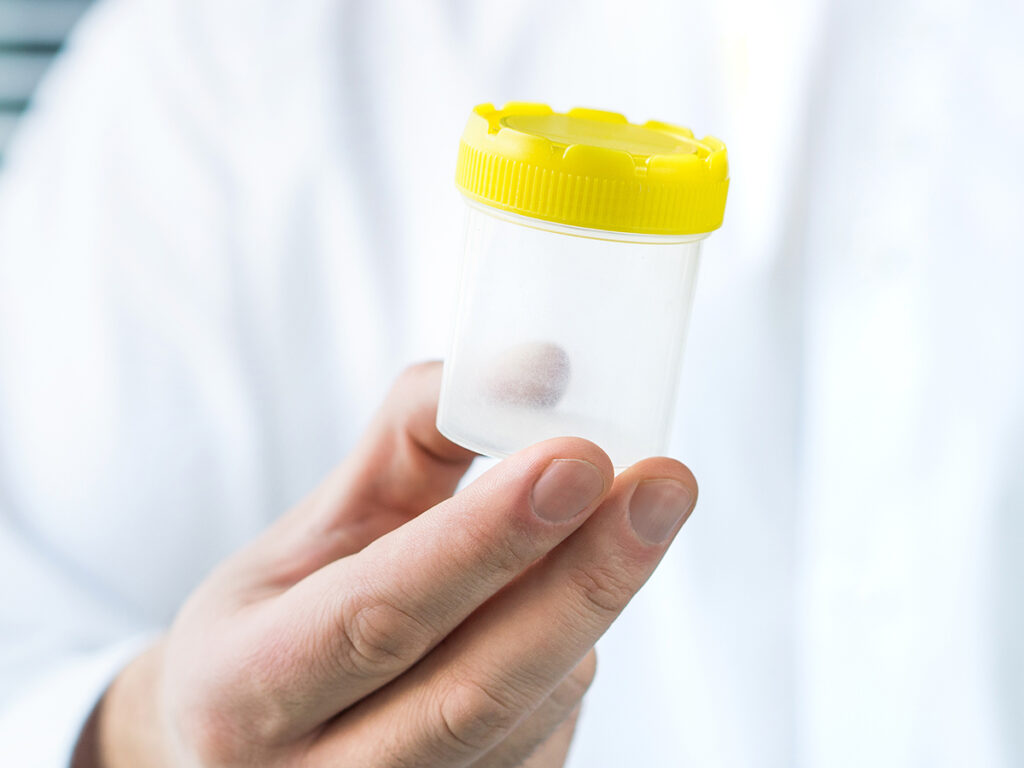 Doctor holding an empty urine screen cup with a yellow lid