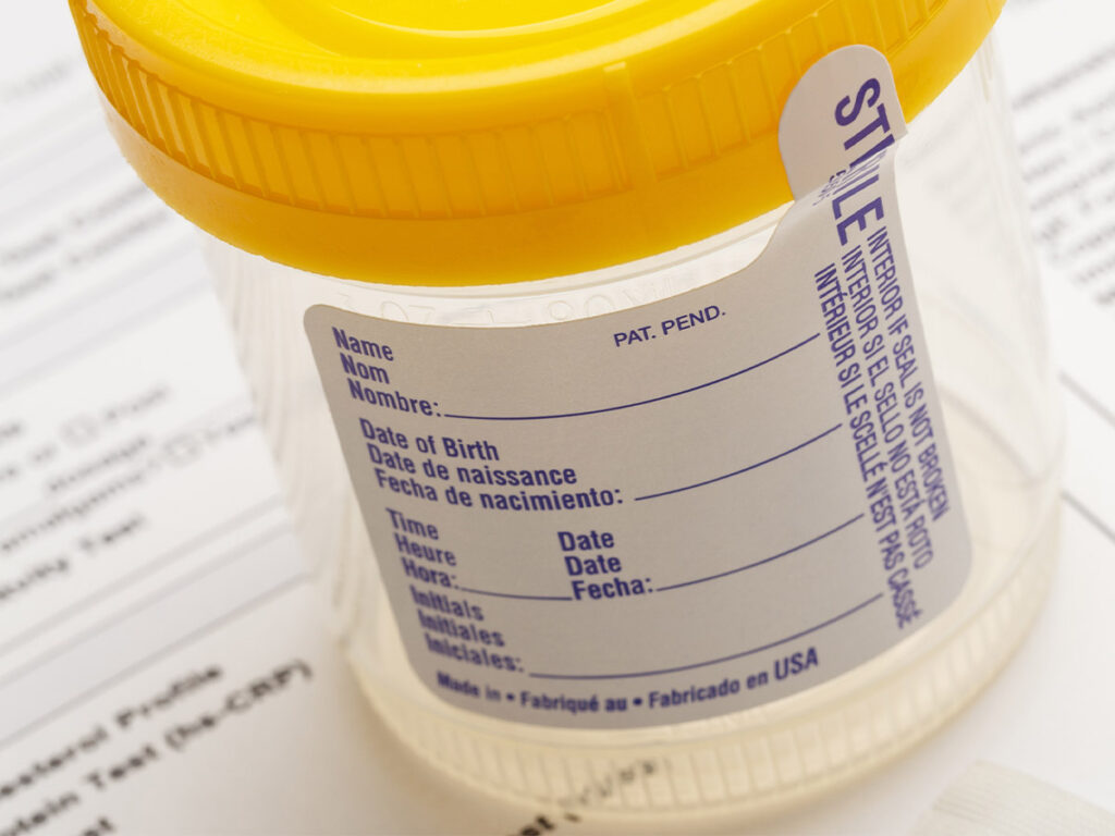 An empty urine sample collection cup with alcohol prep pad.